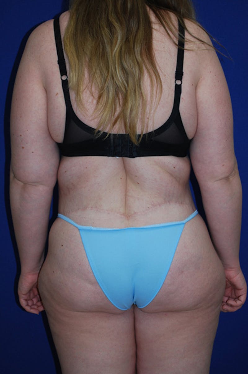 Circumferential Body Lift Before & After Gallery - Patient 298654 - Image 8