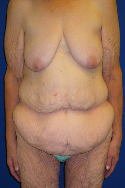 Circumferential Body Lift Before & After Gallery - Patient 495671 - Image 1