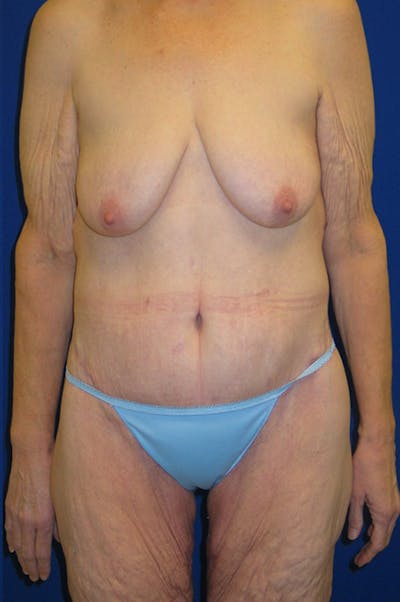 Circumferential Body Lift Before & After Gallery - Patient 495671 - Image 2