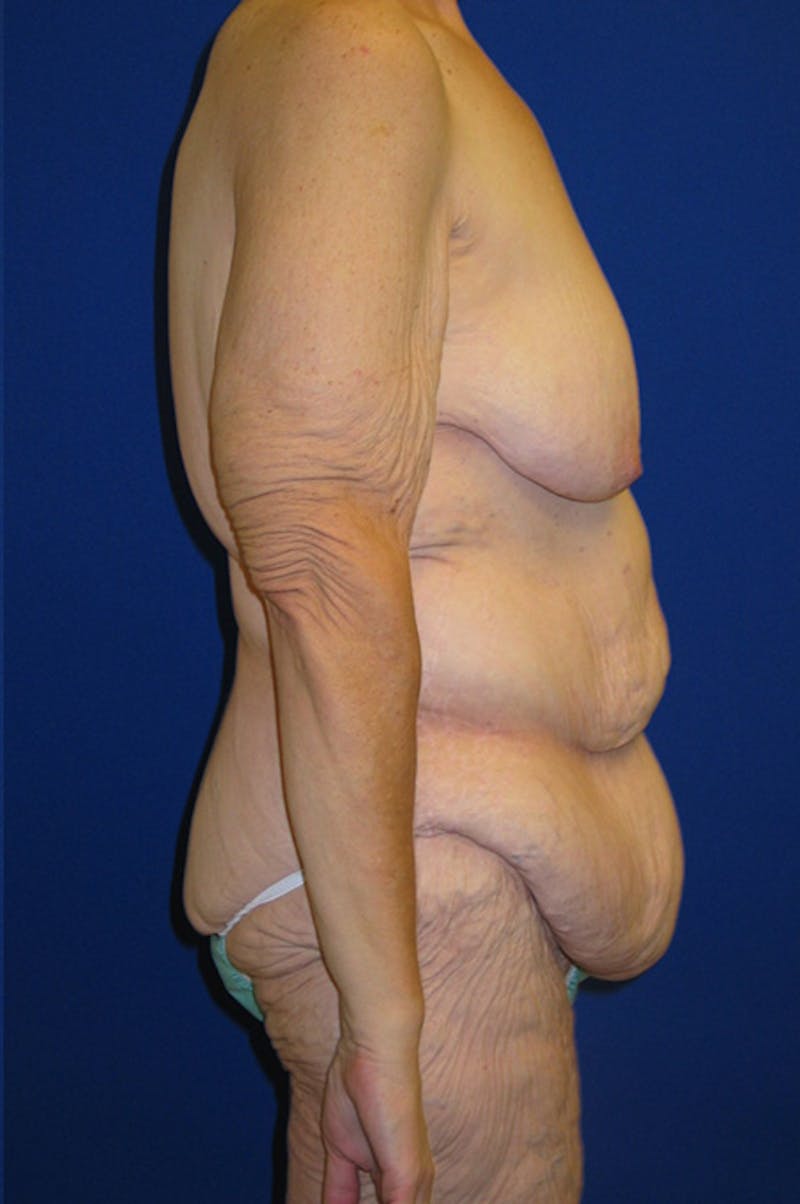 Circumferential Body Lift Before & After Gallery - Patient 495671 - Image 3