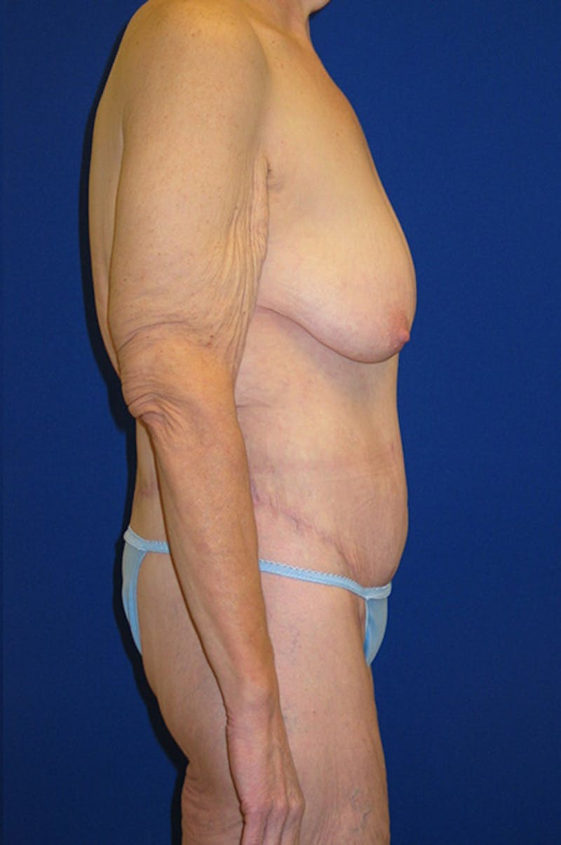 Circumferential Body Lift Before & After Gallery - Patient 495671 - Image 4
