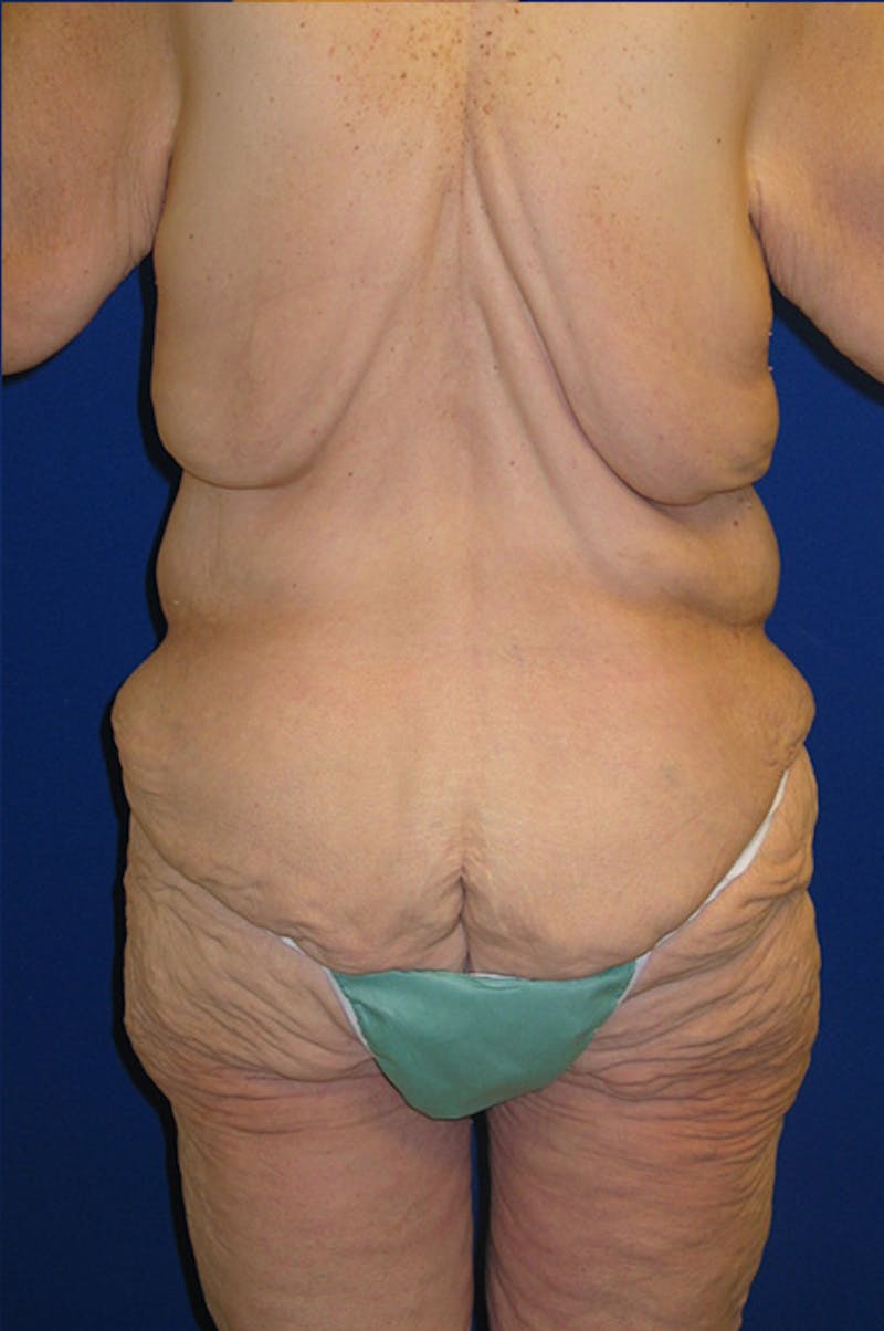 Circumferential Body Lift Before & After Gallery - Patient 495671 - Image 5
