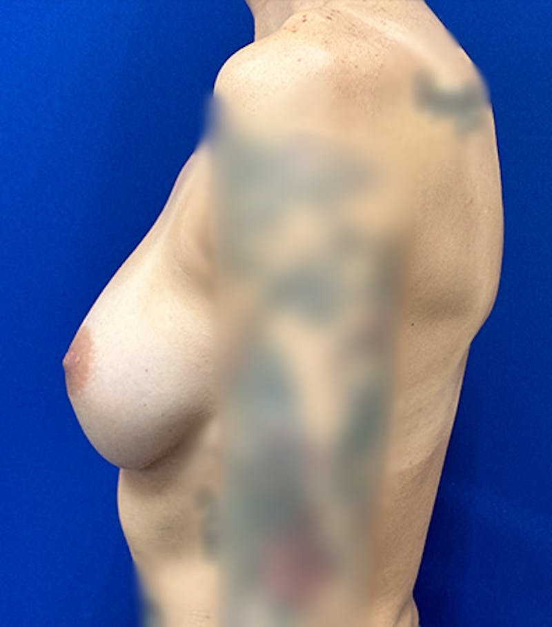 Augmentation Revision Before & After Gallery - Patient 362659 - Image 6