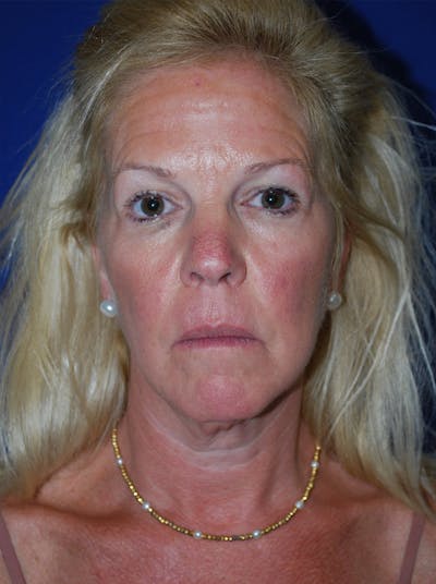 Facelift Before & After Gallery - Patient 255953 - Image 1
