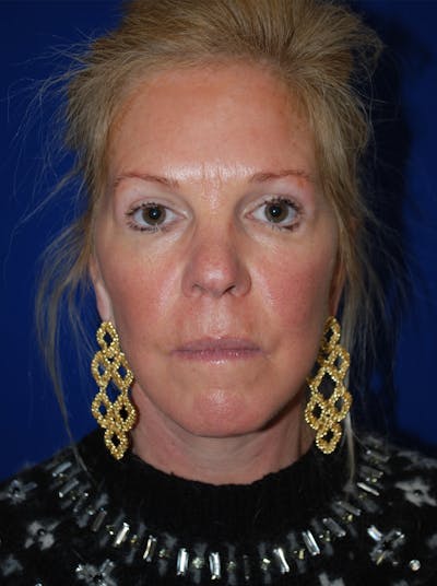 Facelift Before & After Gallery - Patient 255953 - Image 2
