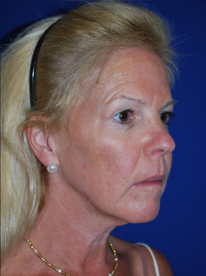 Facelift Before & After Gallery - Patient 255953 - Image 3
