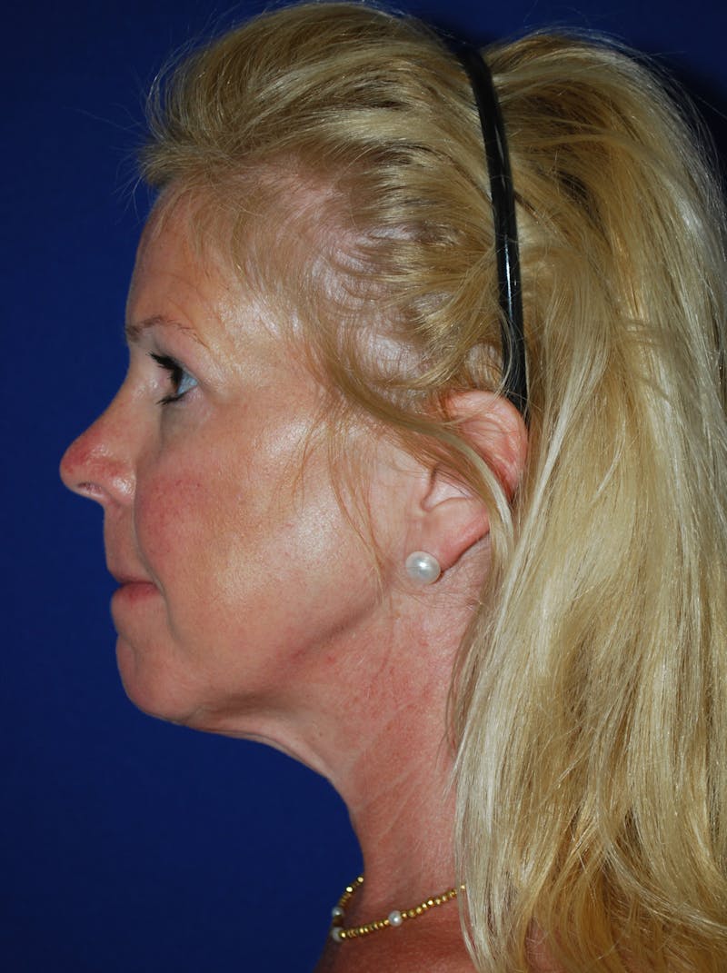 Facelift Before & After Gallery - Patient 255953 - Image 7