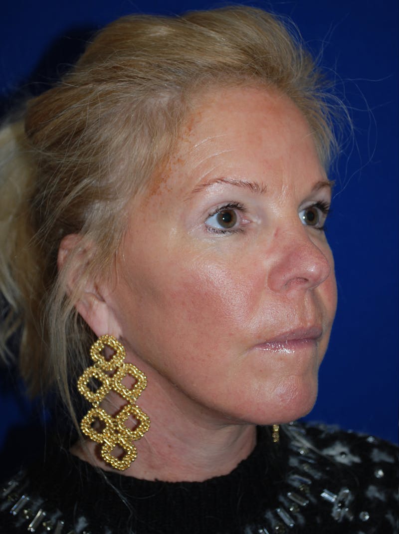 Facelift Before & After Gallery - Patient 255953 - Image 4