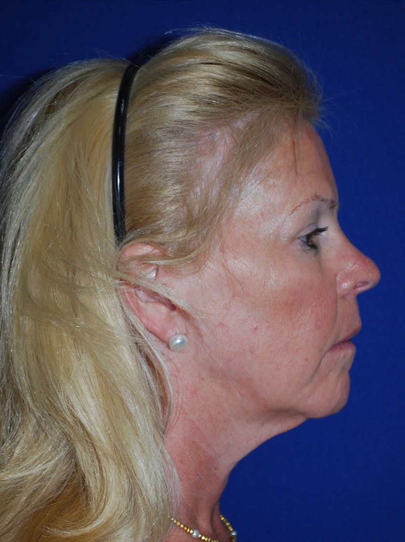 Facelift Before & After Gallery - Patient 255953 - Image 5