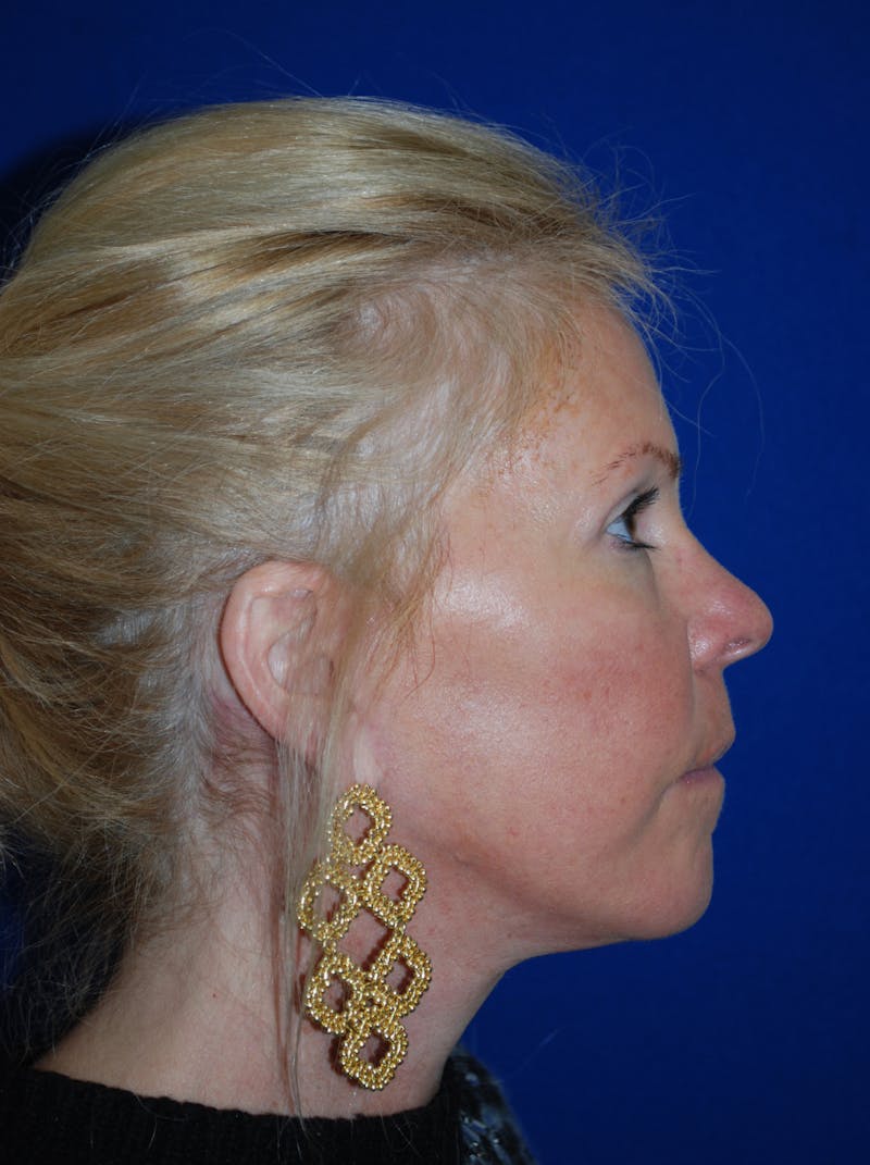 Facelift Before & After Gallery - Patient 255953 - Image 6