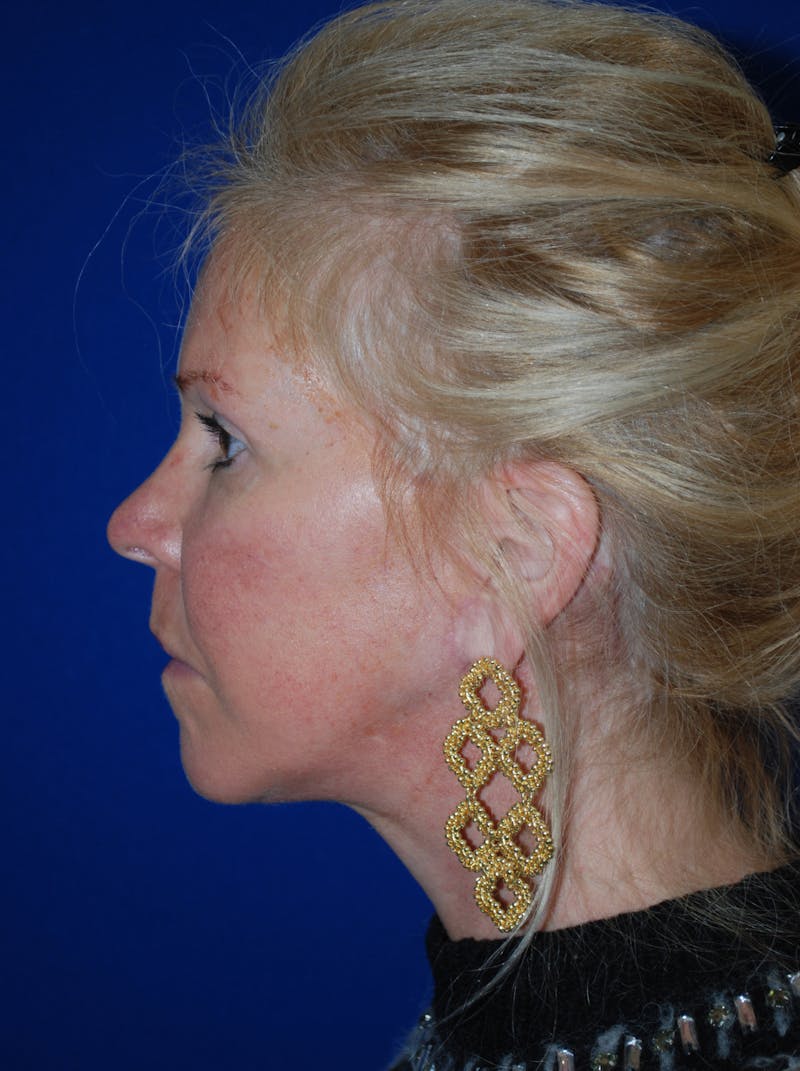 Facelift Before & After Gallery - Patient 255953 - Image 8