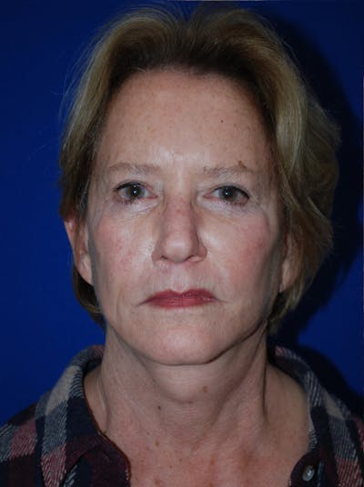 Facelift Before & After Gallery - Patient 226297 - Image 2