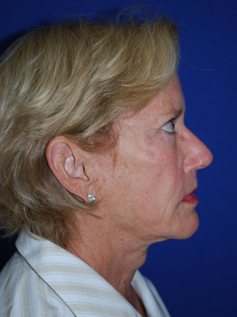 Facelift Before & After Gallery - Patient 226297 - Image 3