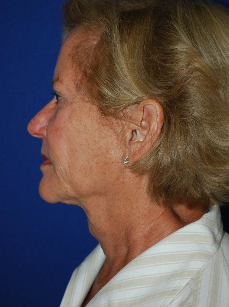 Facelift Before & After Gallery - Patient 226297 - Image 5