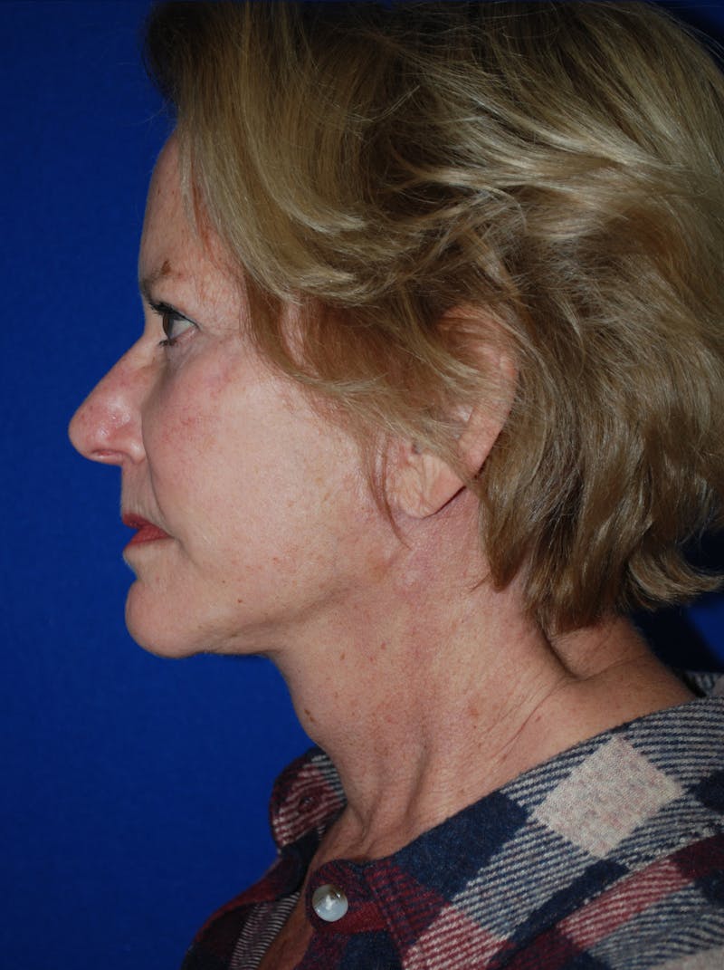 Facelift Before & After Gallery - Patient 226297 - Image 6