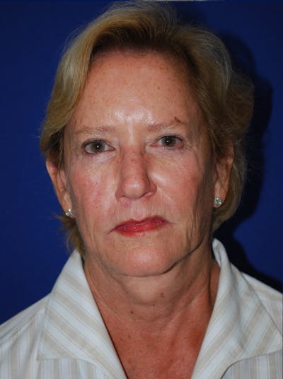 Facelift Before & After Gallery - Patient 226297 - Image 1