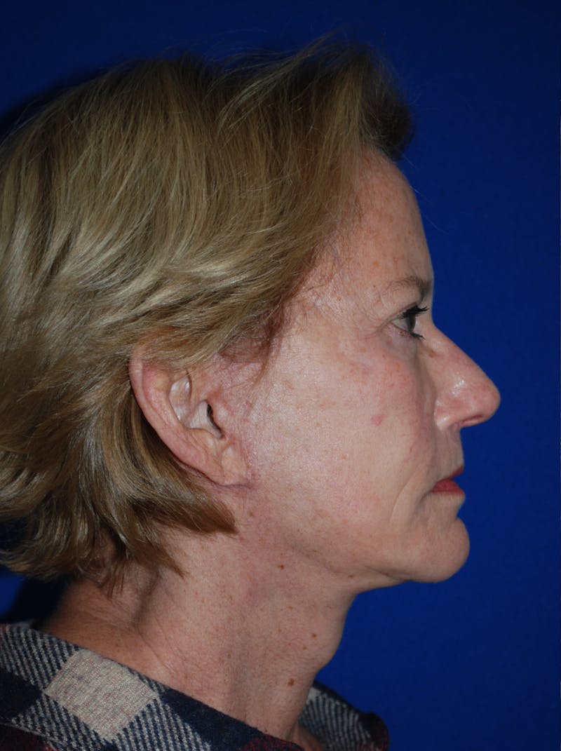 Facelift Before & After Gallery - Patient 226297 - Image 4