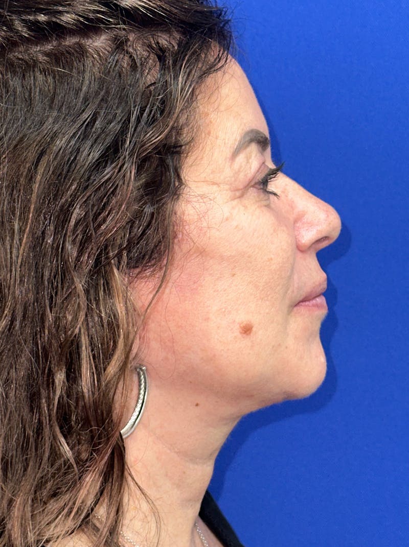 Facelift Before & After Gallery - Patient 256503 - Image 6