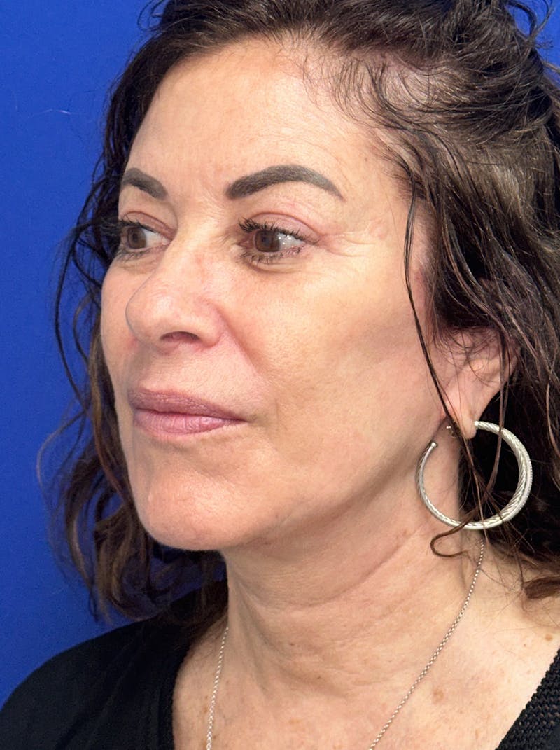Facelift Before & After Gallery - Patient 256503 - Image 8