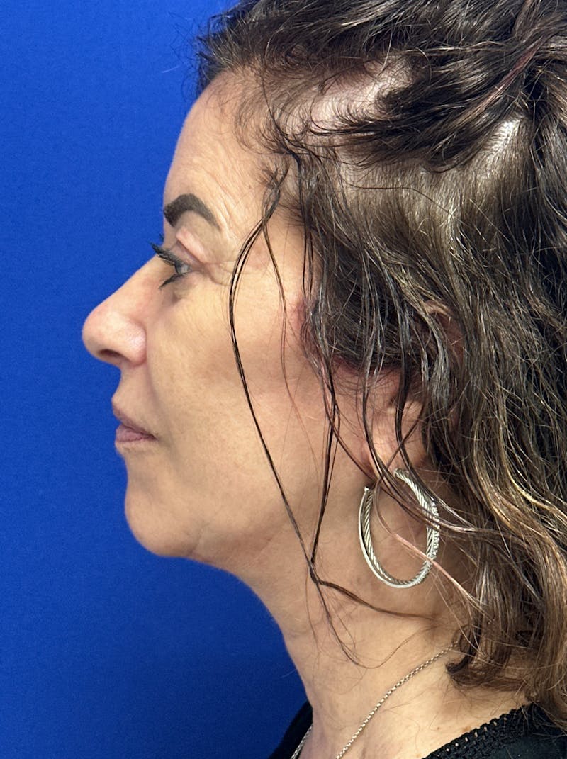 Facelift Before & After Gallery - Patient 256503 - Image 10