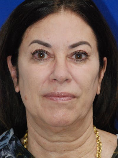 Facelift Before & After Gallery - Patient 256503 - Image 1