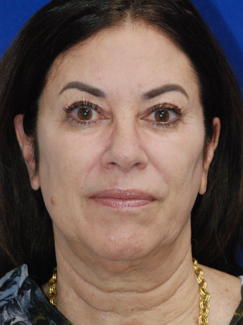 Facelift Before & After Gallery - Patient 256503 - Image 1