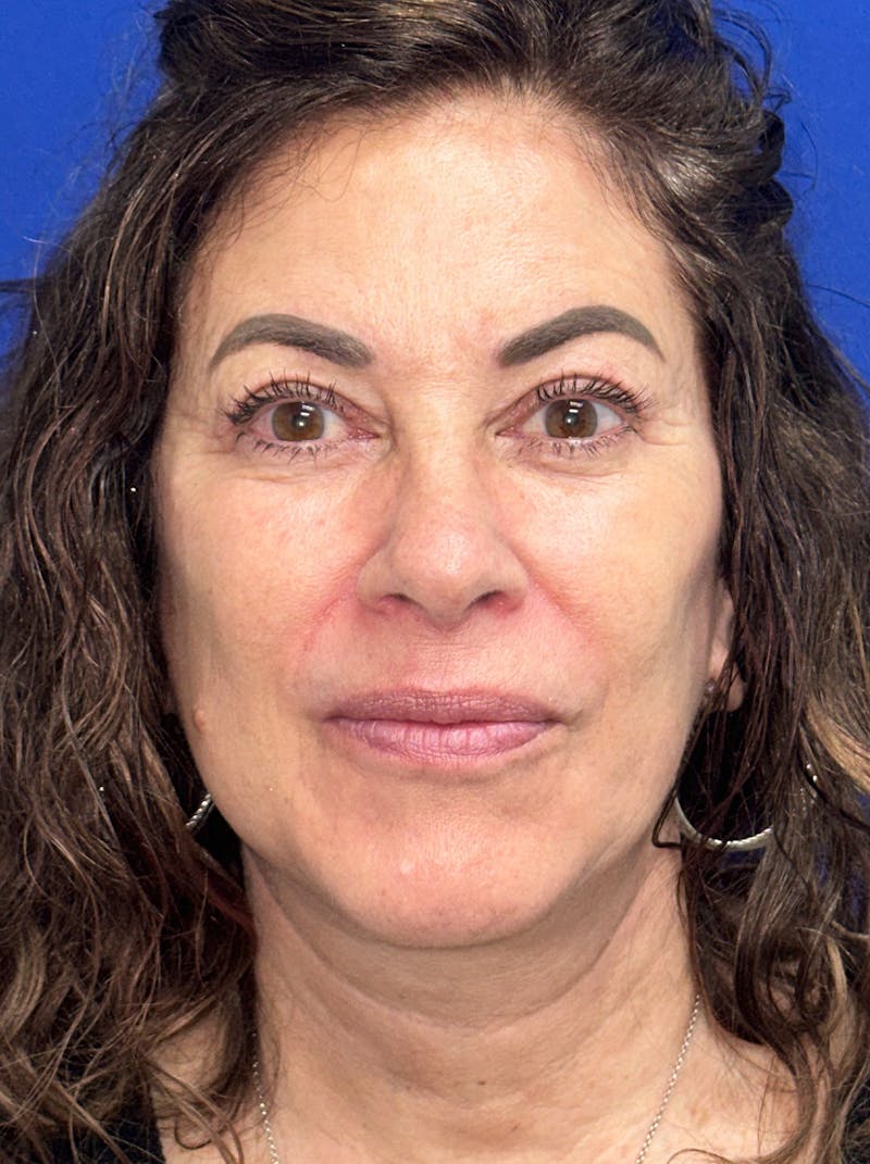 Facelift Before & After Gallery - Patient 256503 - Image 2