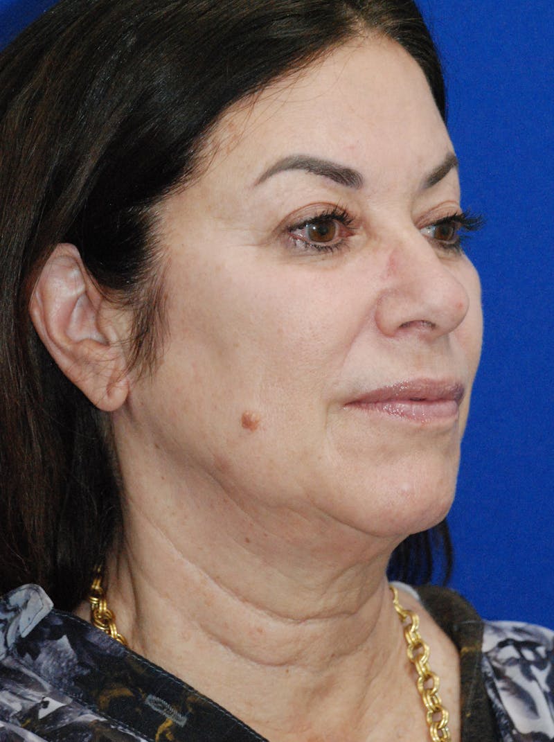 Facelift Before & After Gallery - Patient 256503 - Image 3