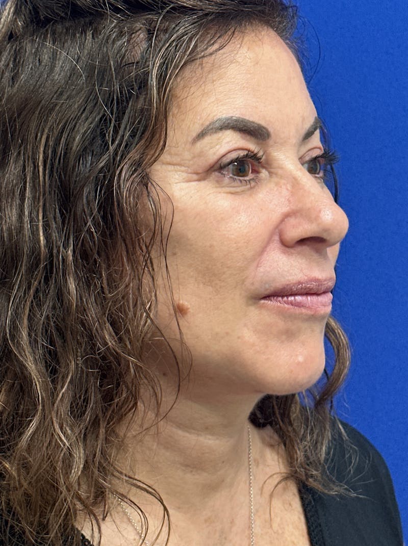 Facelift Before & After Gallery - Patient 256503 - Image 4