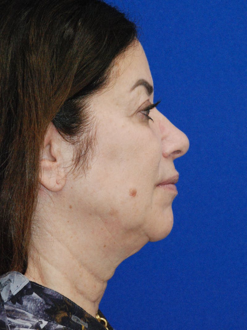 Facelift Before & After Gallery - Patient 256503 - Image 5