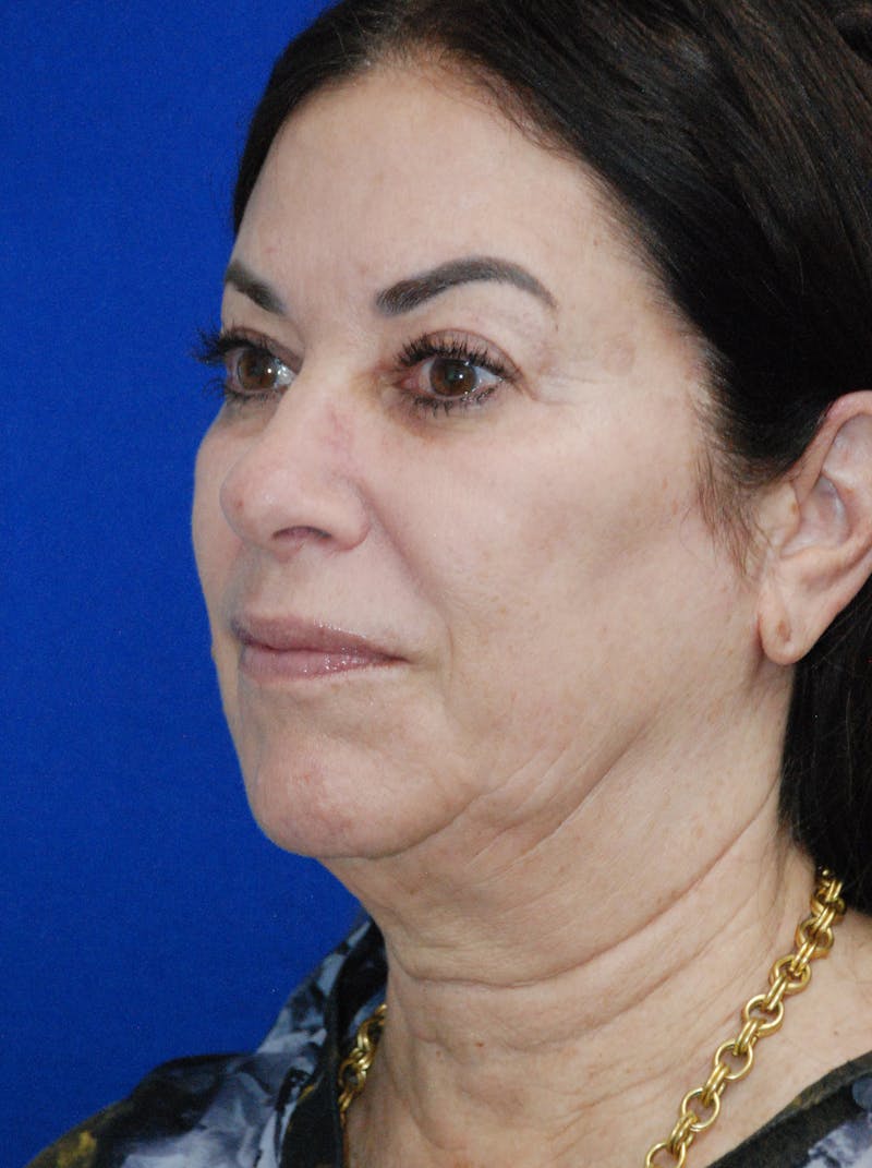 Facelift Before & After Gallery - Patient 256503 - Image 7
