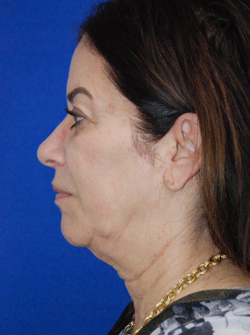 Facelift Before & After Gallery - Patient 256503 - Image 9