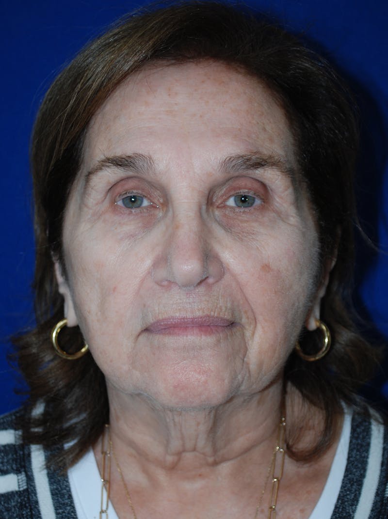 Facelift Before & After Gallery - Patient 117910 - Image 1