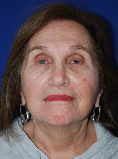 Facelift Before & After Gallery - Patient 117910 - Image 2