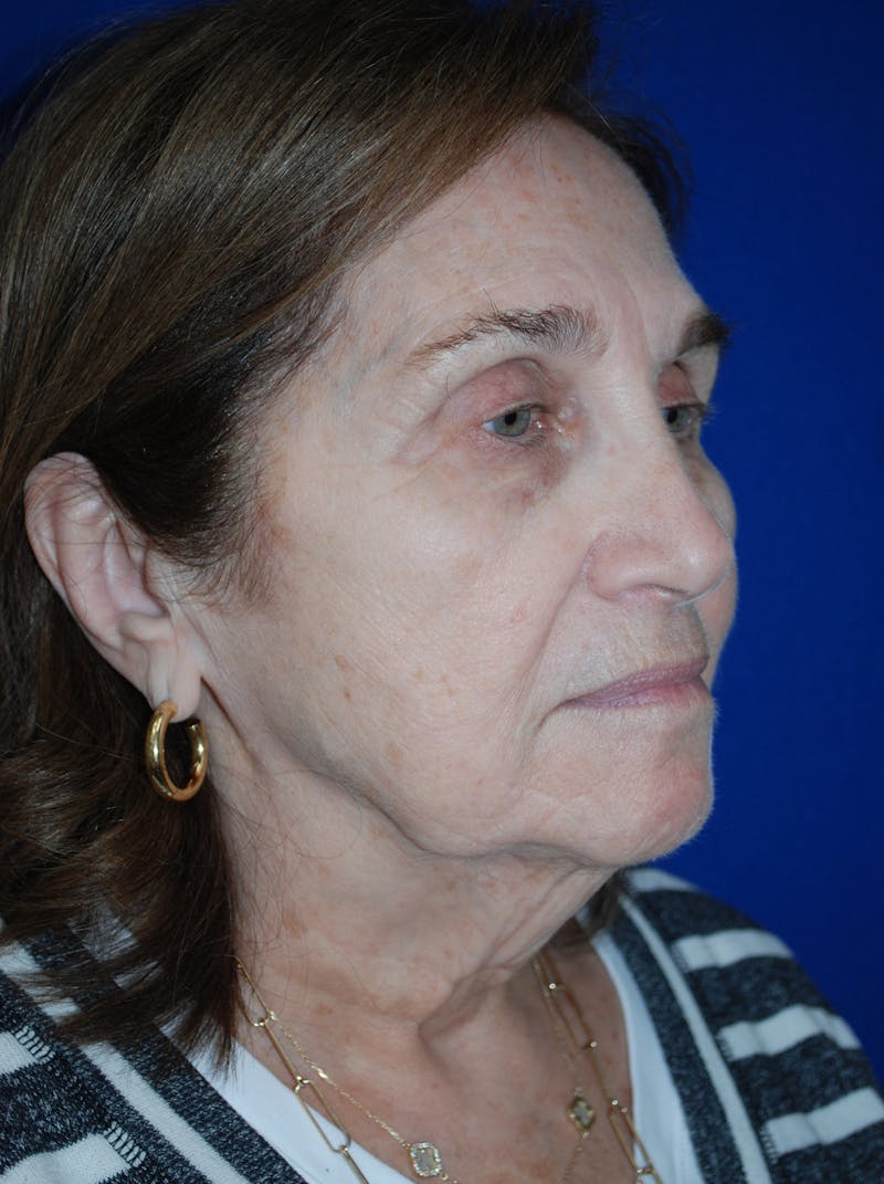 Facelift Before & After Gallery - Patient 117910 - Image 3