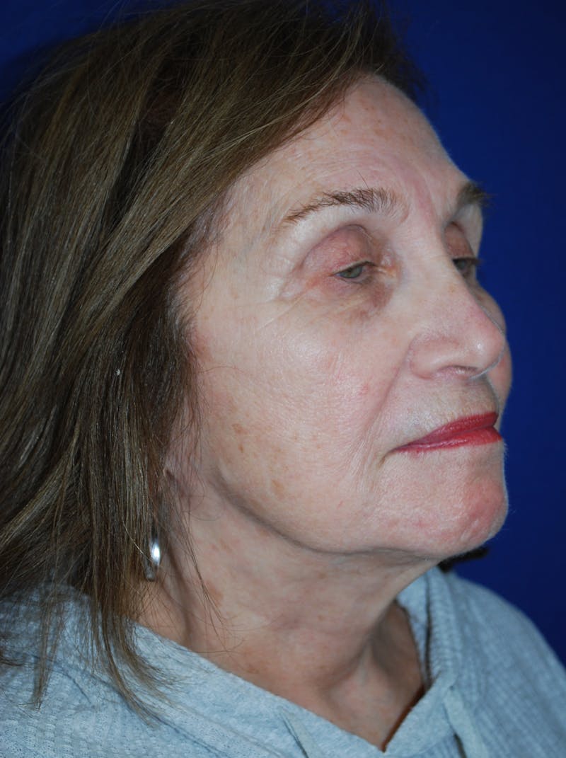 Facelift Before & After Gallery - Patient 117910 - Image 4