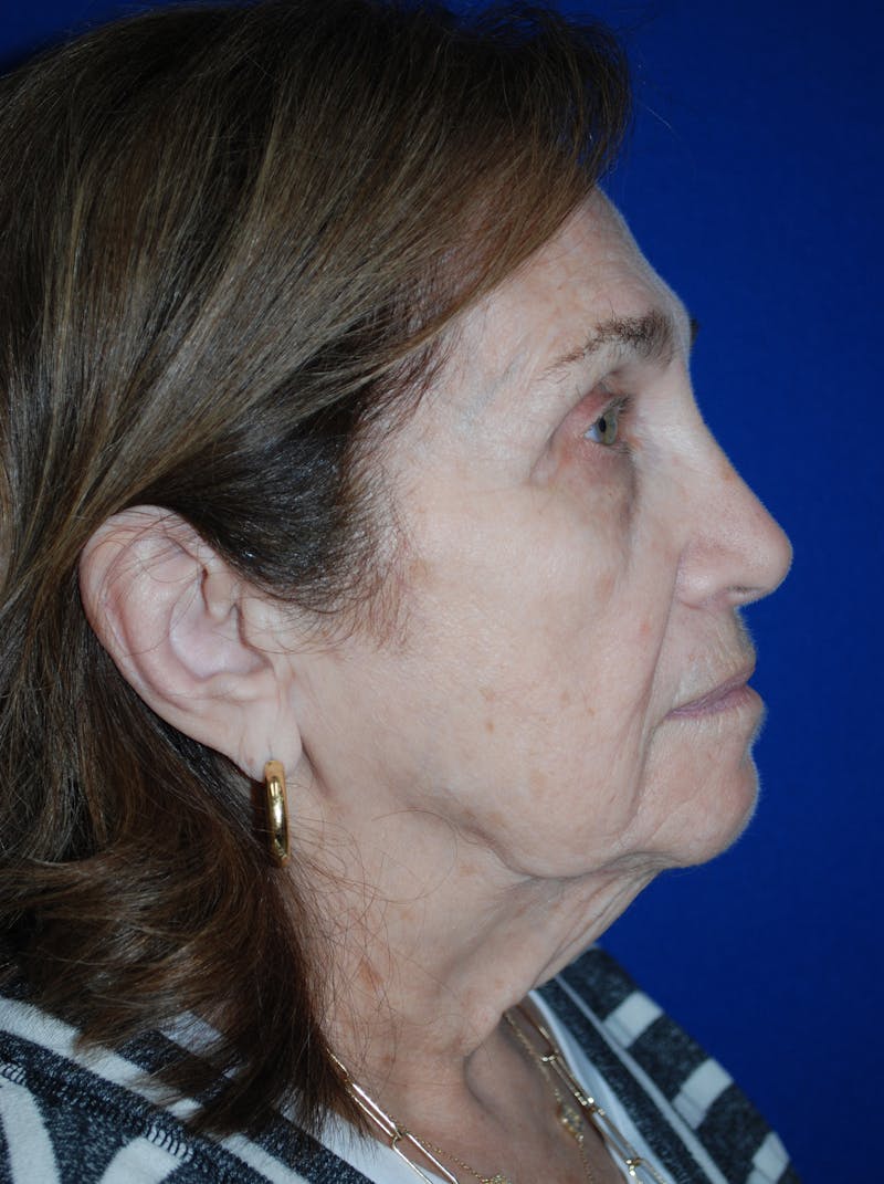 Facelift Before & After Gallery - Patient 117910 - Image 5