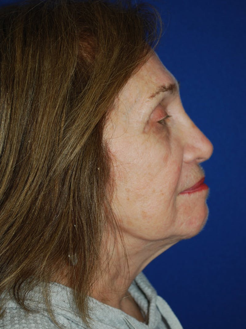 Facelift Before & After Gallery - Patient 117910 - Image 6