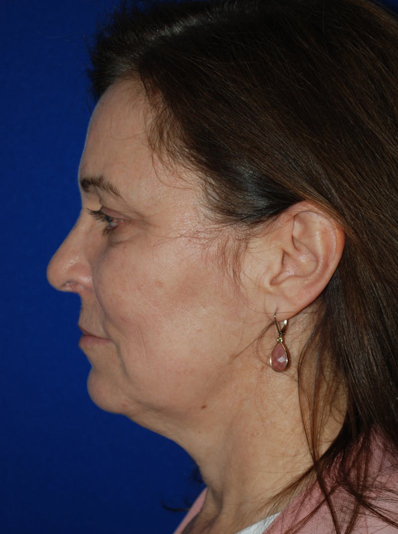 Facelift Before & After Gallery - Patient 214197 - Image 9