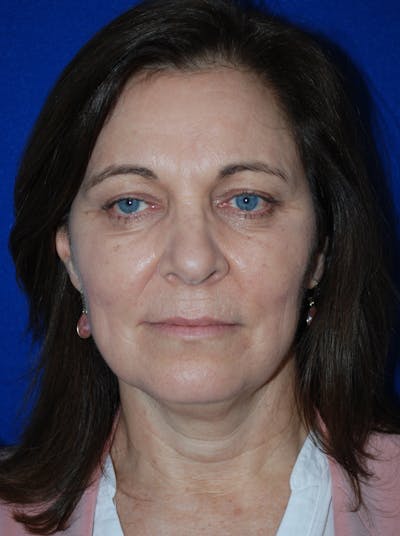 Facelift Before & After Gallery - Patient 214197 - Image 1