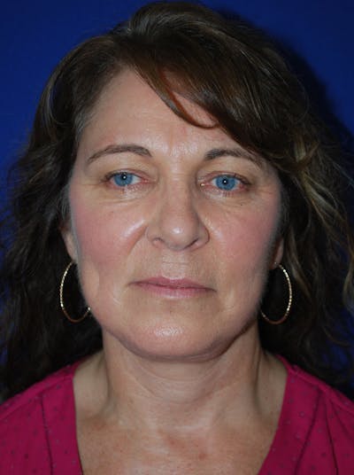 Facelift Before & After Gallery - Patient 214197 - Image 2