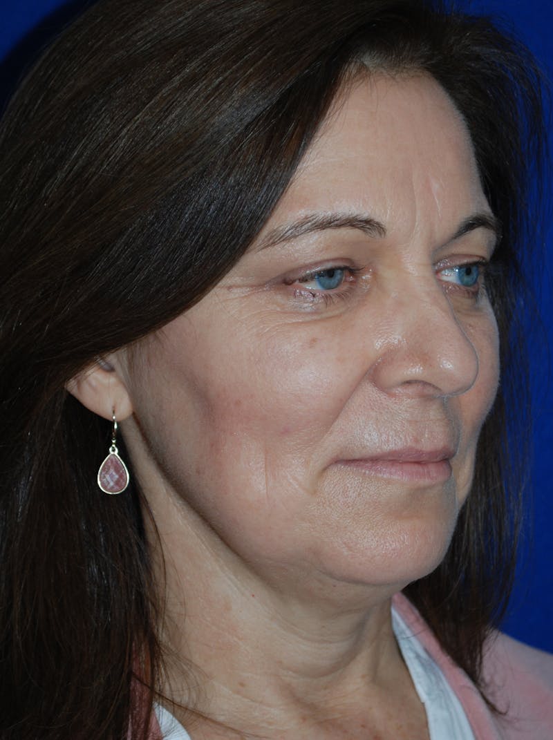 Facelift Before & After Gallery - Patient 214197 - Image 3
