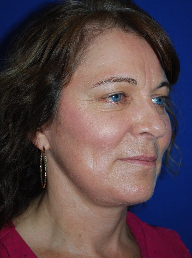 Facelift Before & After Gallery - Patient 214197 - Image 4