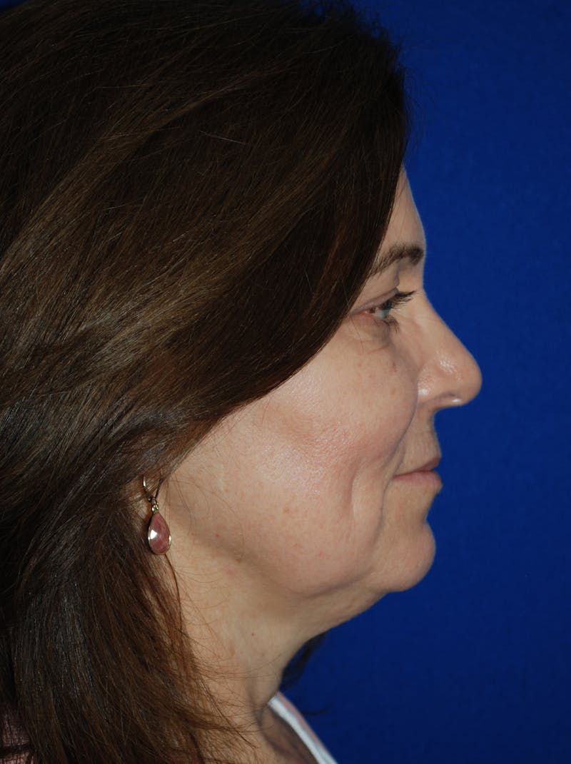 Facelift Before & After Gallery - Patient 214197 - Image 5