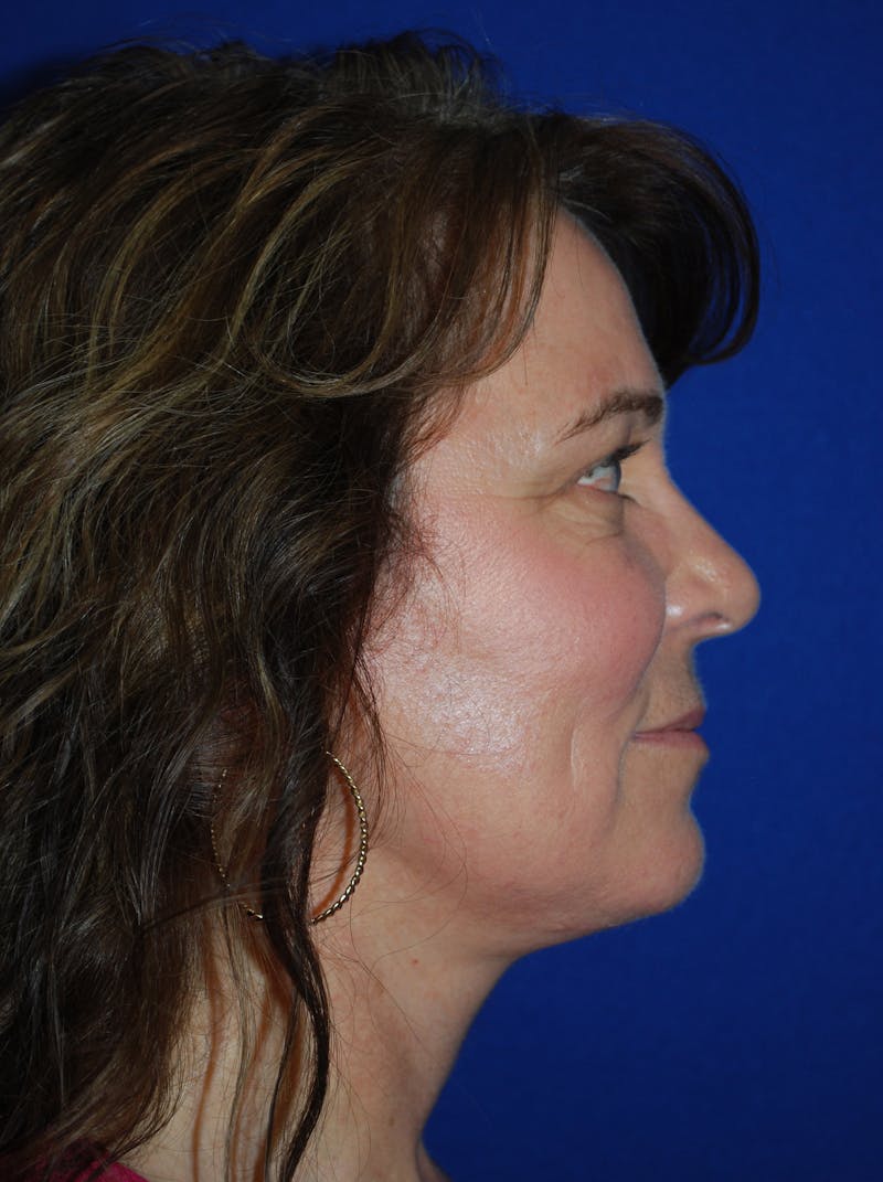 Facelift Before & After Gallery - Patient 214197 - Image 6