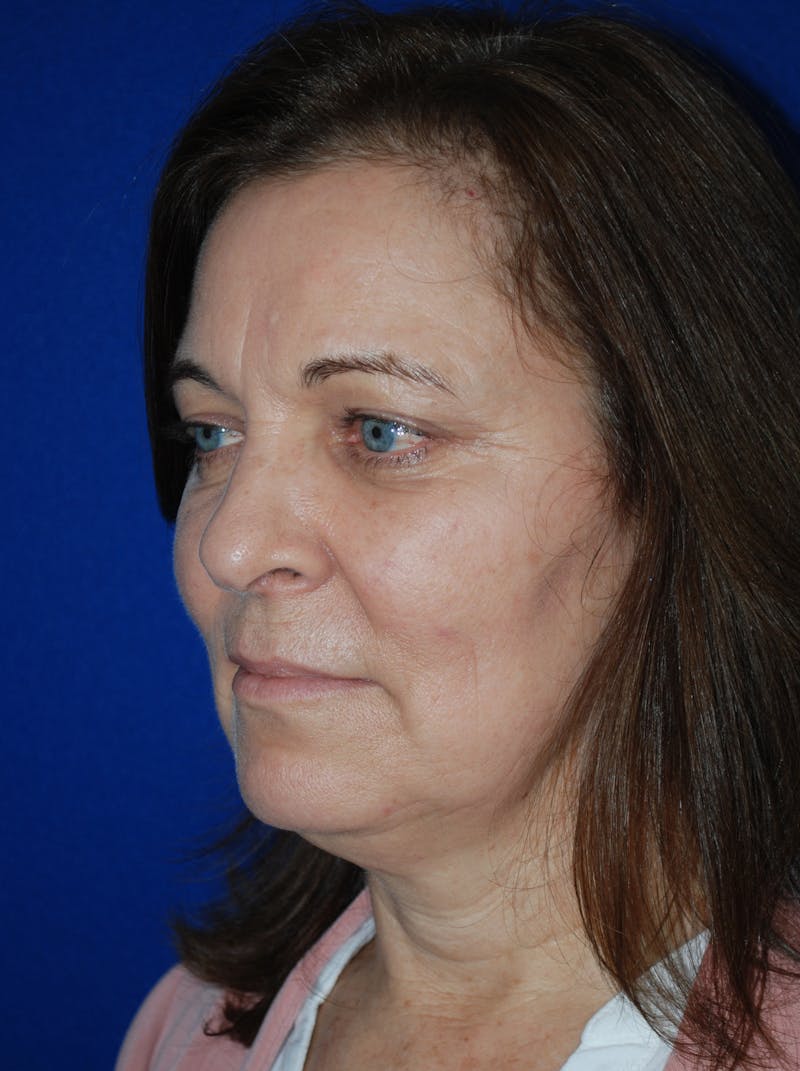 Facelift Before & After Gallery - Patient 214197 - Image 7