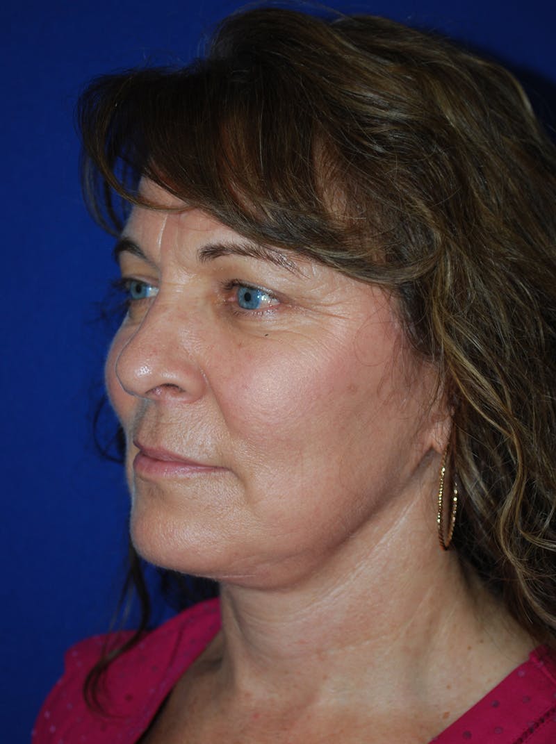 Facelift Before & After Gallery - Patient 214197 - Image 8