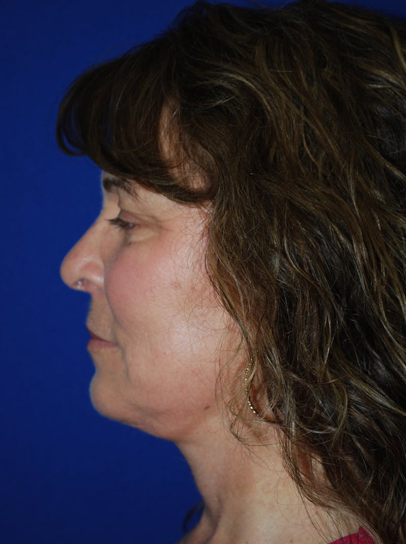 Facelift Before & After Gallery - Patient 214197 - Image 10