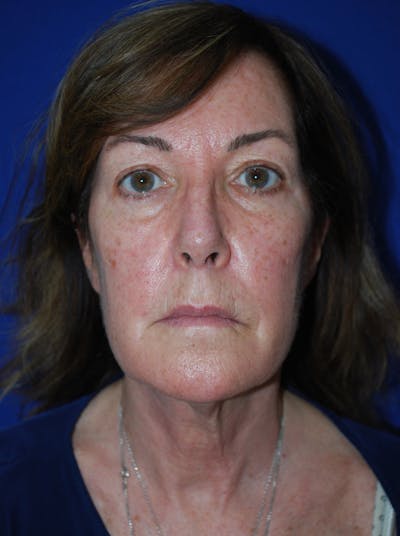Facelift Before & After Gallery - Patient 309580 - Image 1