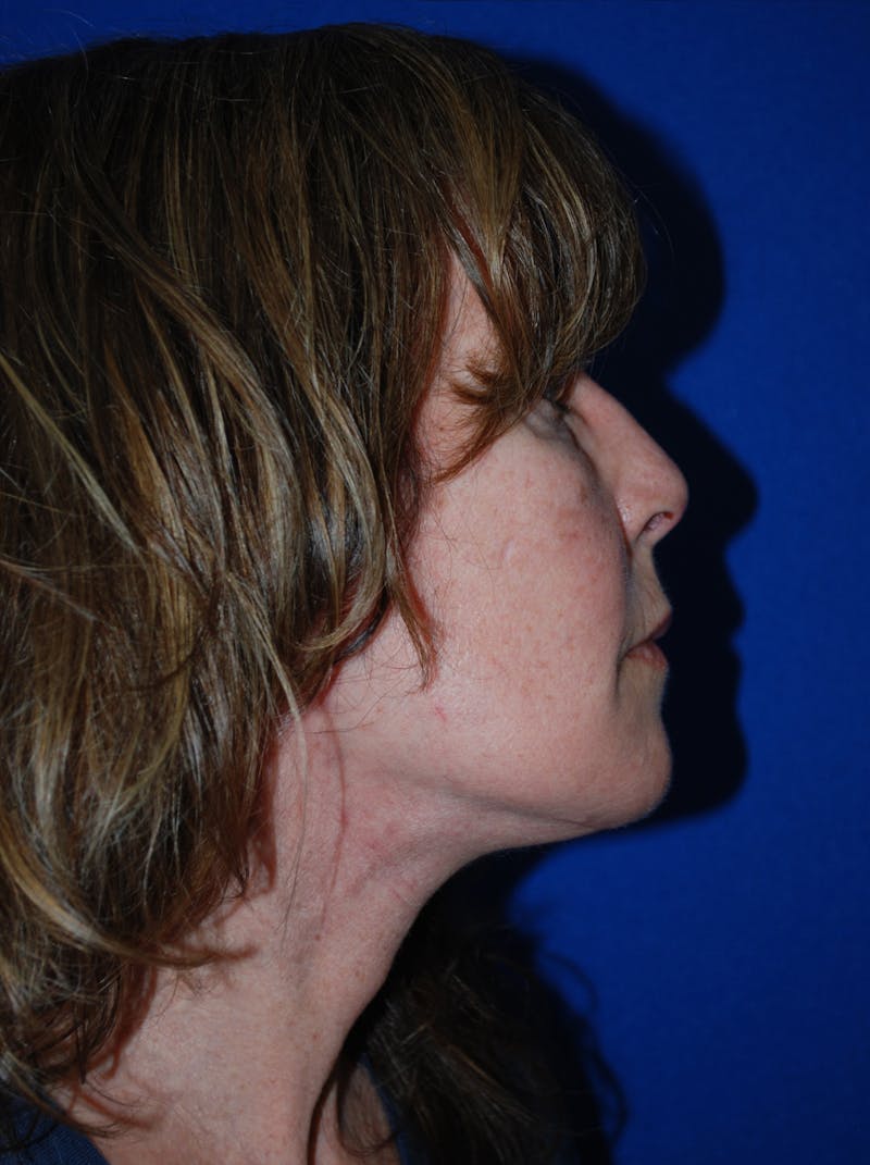 Facelift Before & After Gallery - Patient 309580 - Image 4